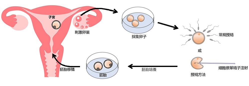 Schematic diagram of IVF treatment