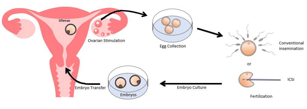 Schematic diagram of IVF treatment