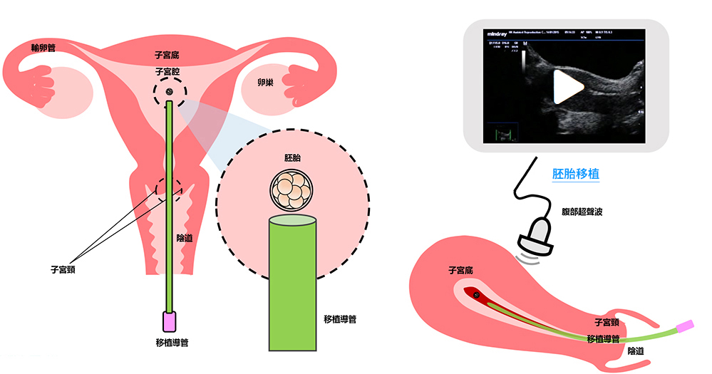 Embryo Transfer