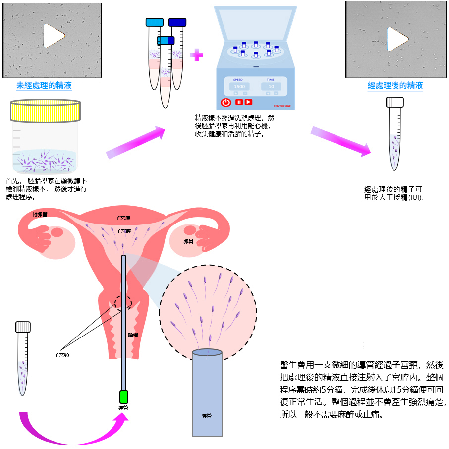 healthy and active sperm are collected