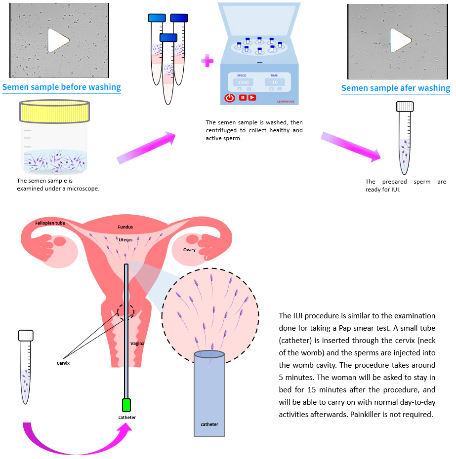 healthy and active sperm are collected