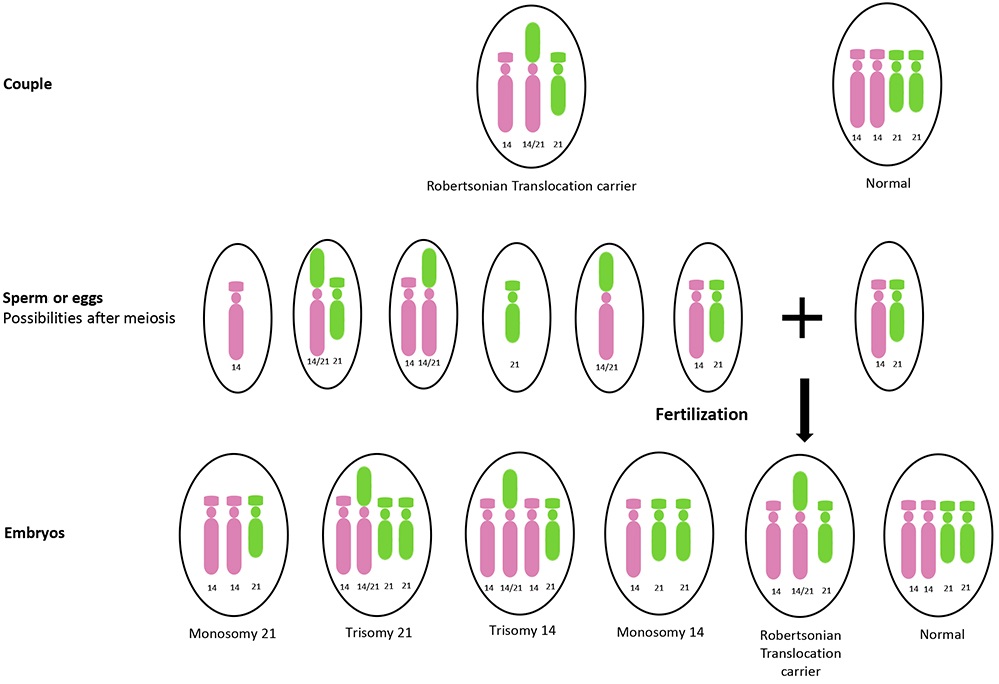 Robertsonian Translocation Gene map