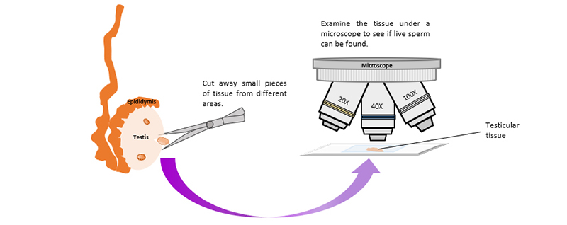 Testicular sperm extraction